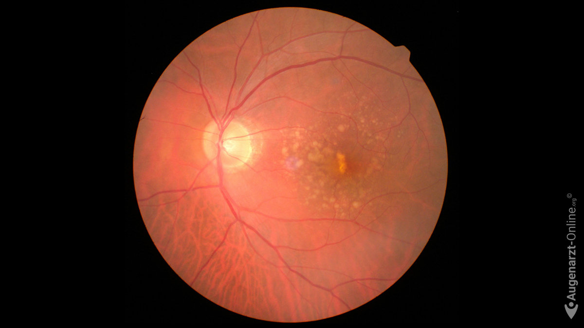 Sind Drusen Im Auge Gefährlich